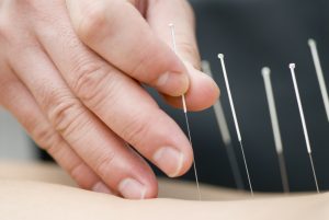 A closeup of a therapist's hand inserting an acupuncture needle into a person's skin.