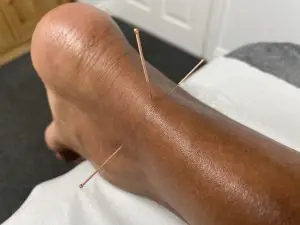 Three acupuncture needles inserted in a cross-shaped pattern in the lower Achilles tendon
